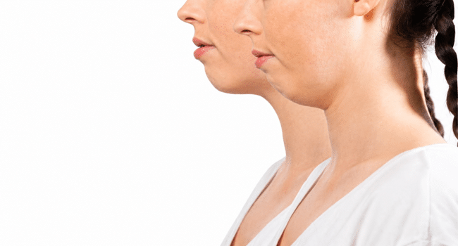 Chin Liposuction Bruising