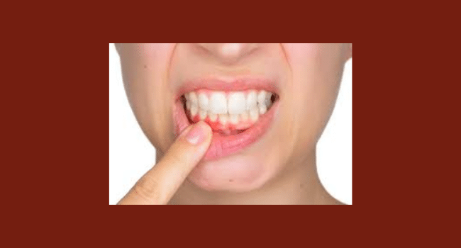 Dental Abscess Emergency
