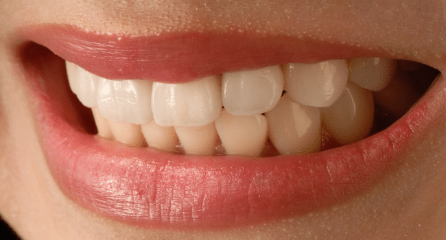 Dental Veneers