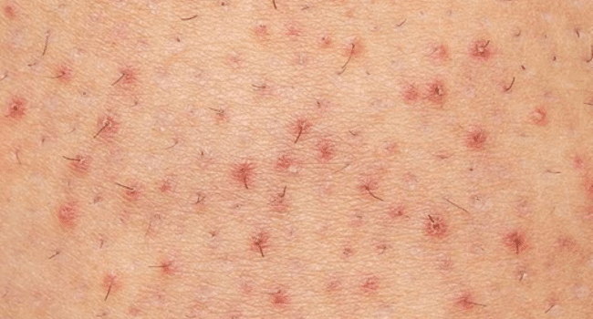 Dermatologist in Bangalore