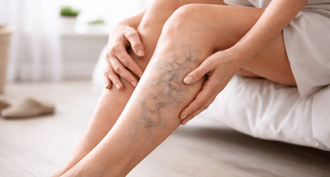 Early Signs of Varicose Veins