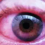 Eye Treatment, Red Eyes