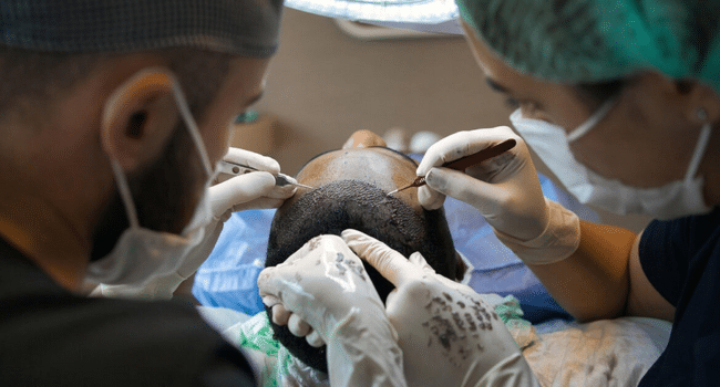 Hair System vs. Hair Transplant