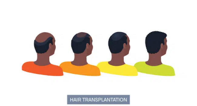 Hair Transplant