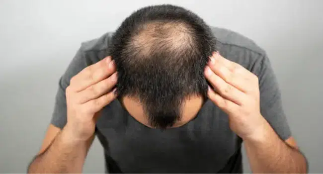 Hair Transplant