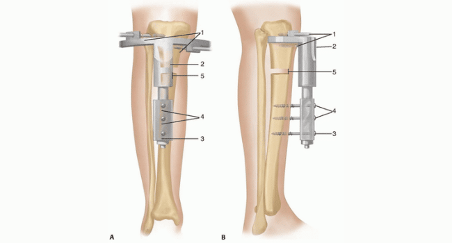 Limb Reconstruction