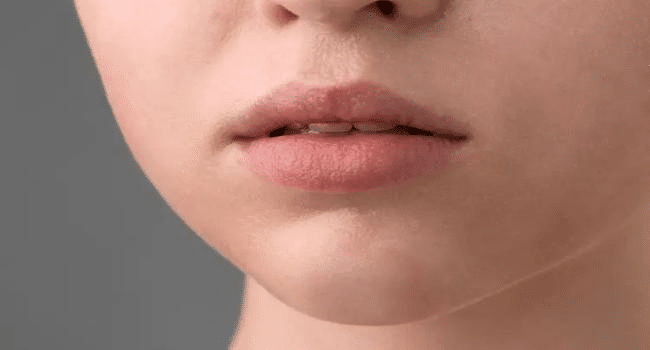 Lip Hydration vs Lip Filler
