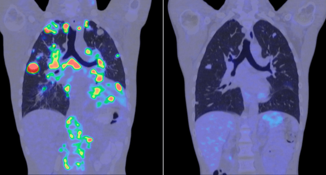 Lymphocytic Leukemia Conditions and Indications