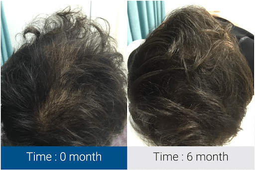 Modern Hair Loss Solutions