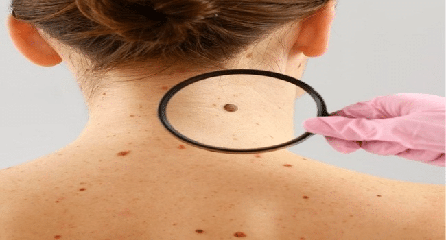 Mole Removal in Dubai