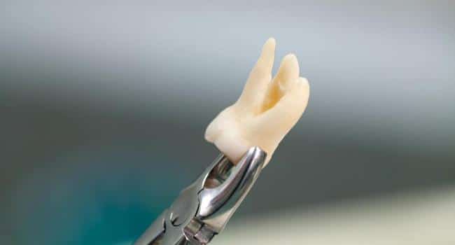 Most Difficult Dental Procedure