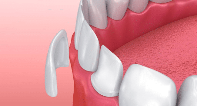 Porcelain Veneers