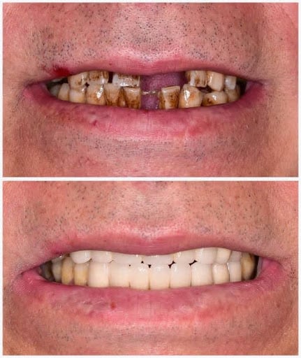 Replacing missing teeth