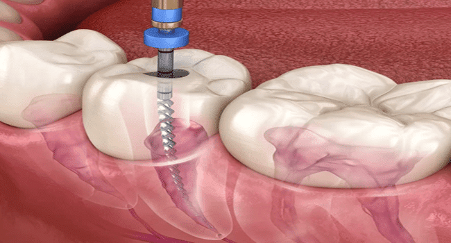 Root Canal Treatment
