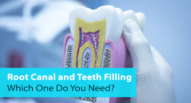 Root Canal and Teeth Filling