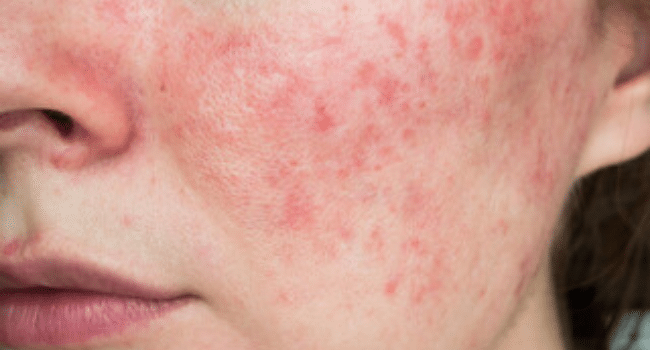 Rosacea