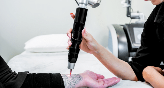 Tattoo Removal in Sydney