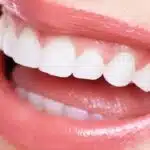Treat Your Teeth Without Braces