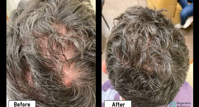 Treatment for Hair Loss