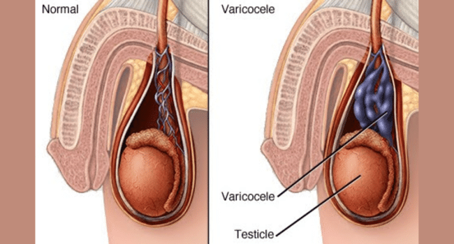 Varicocele Repair