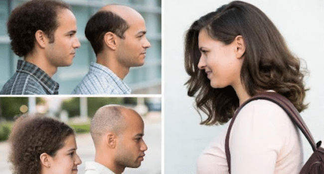 What Causes Hair Loss