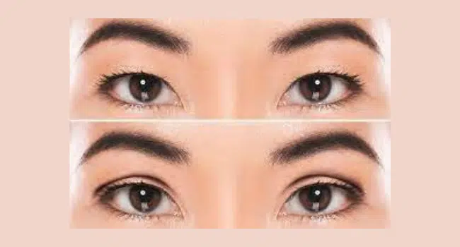 double eyelid surgery