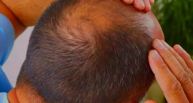 hair transplant