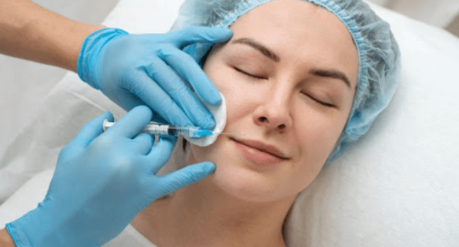 Nasolabial Fold Filler